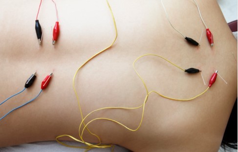 Electro-Acupuncture  Piedmont Acupuncture and Oriental Medicine